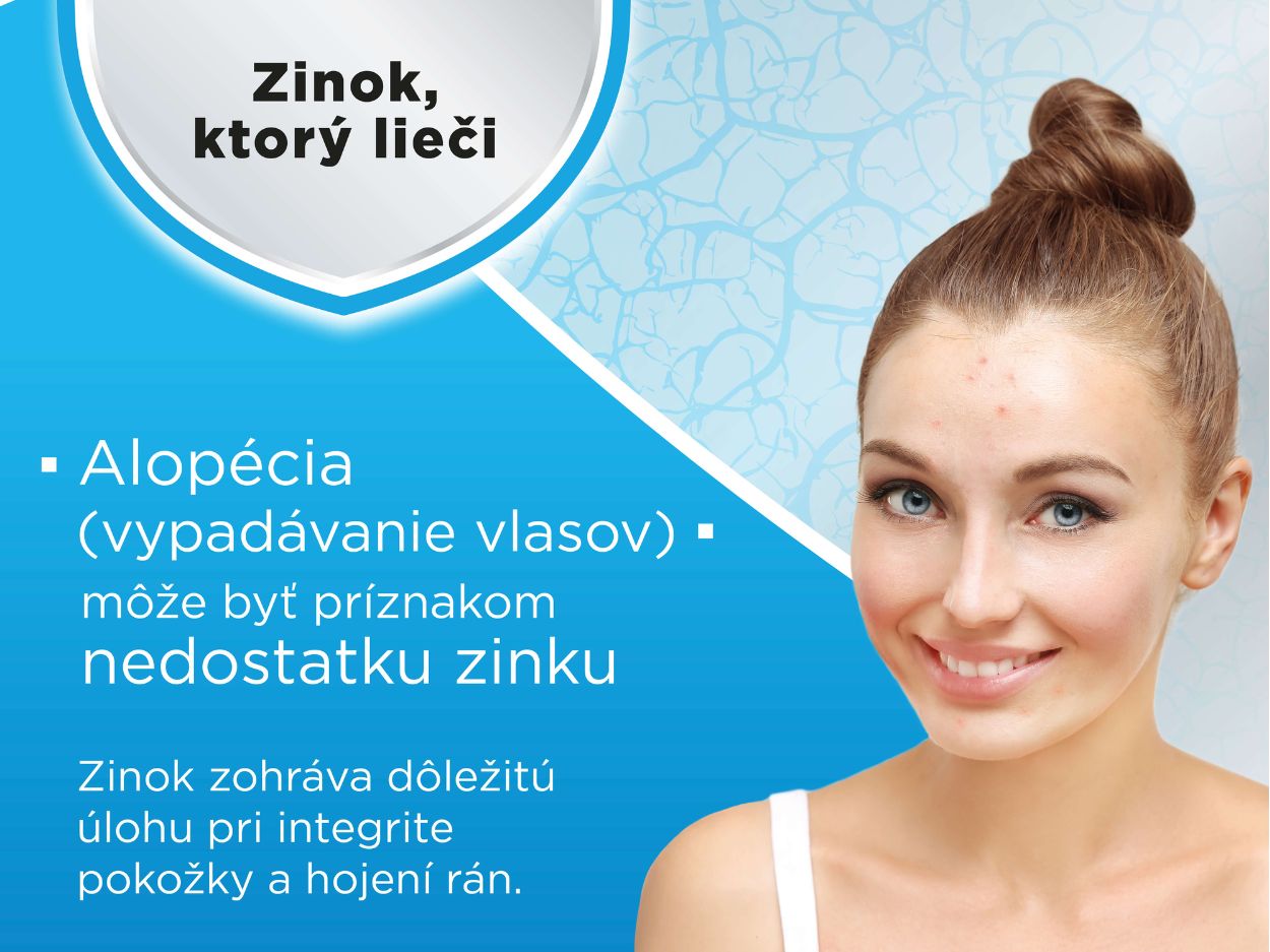 Alopécia - vypadávanie vlasov môže byť príznakom nedostatku zinku