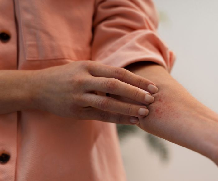 Dermatitída: Príčiny, druhy a liečba
